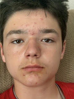 before: close-up of a young man's face with active breakouts on the forehead, cheeks and chin