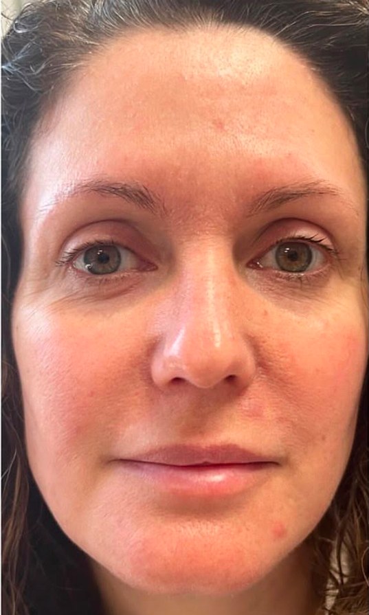 before · wrinkle