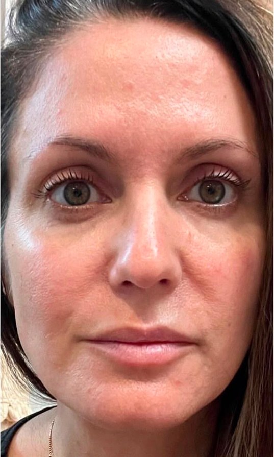 after · wrinkle