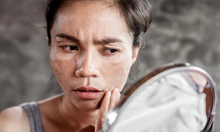 What Causes Brown Spots & How to Treat Them